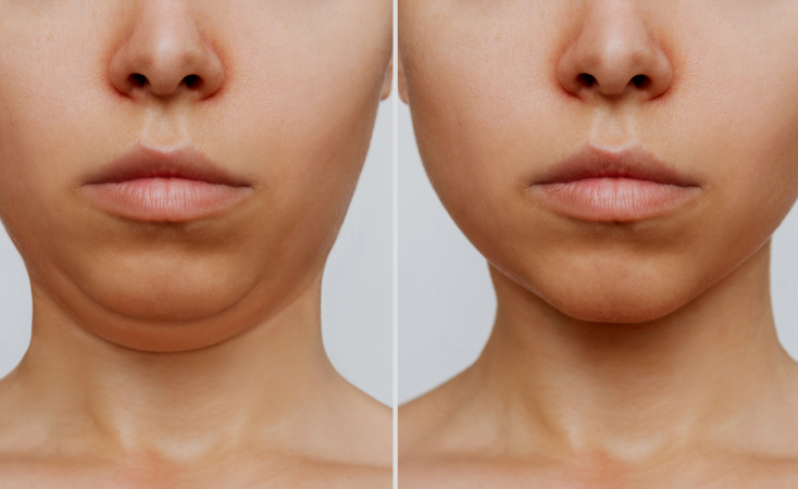 chin hermonization