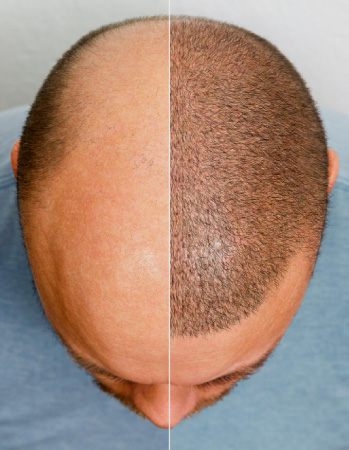 hair transplant